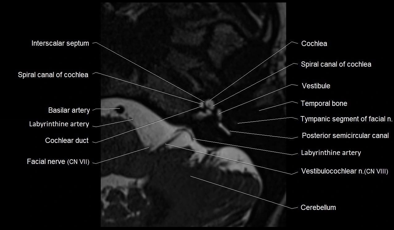 Internal auditory canal (IAC) axial cross sectional anatomy image 8.webp